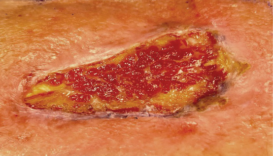 Image of infection 48 hours after administration of KIMYRSA.