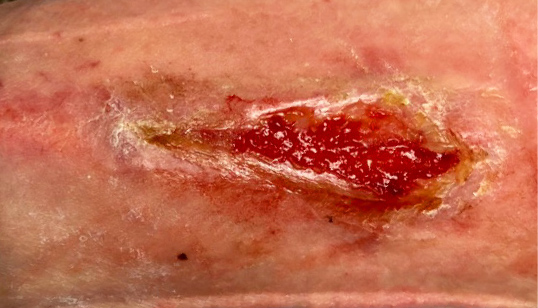 Image of infection 7 days after administration of KIMYRSA.