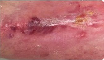 Image of infection 4 weeks after administration of KIMYRSA.